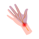 Nerve Related Pain (Neuropathic) Icon